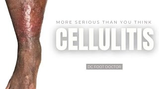 Cellulitis More Serious Than You Think [upl. by Rehpotsirh]