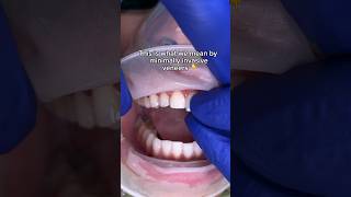 What are minimally invasive veneers 👆🦷 veneers minimalprep porcelainveneers noninvasive [upl. by Cusick]