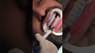 Teeth Whitening Procedure 😱🫣drrehanahmed dentistavenue teethwhitening teethwhitening teethcare [upl. by Isej]