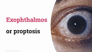 Exophthalmos [upl. by Rehpotsrhc]