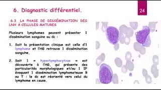 Hemato 13Leucémie lymphoide chronique LLC Dr Abbadi [upl. by Daile18]