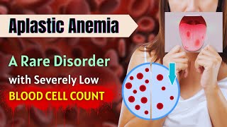 Aplastic Anemia A Rare Disorder With Severely Low Blood Cell Count [upl. by Eelamme]