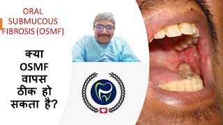 Dr Rudra Mohan  is OSMF reversible  क्या OSMF वापस ठीक हो सकता है Oral Submucous Fibrosis [upl. by Zadoc469]