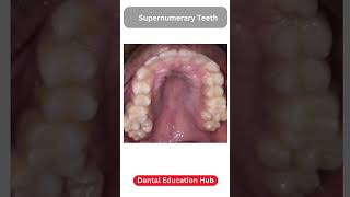 Supernumerary Teeth  Paramolar [upl. by Sherry]