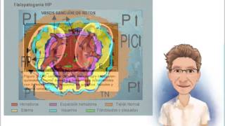 HEMORRAGIA INTRACEREBRAL FISIOPATOLOGÍA [upl. by Sellihca]