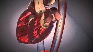 Cardiologie  TAVI Procedure EdwardsXT [upl. by Areemas]