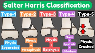 Salter Harris Fracture Classification [upl. by Gnim]