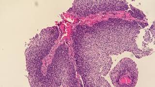 Invasive Non Keratinizing Squamous Cell Carcinoma Moderately Differentiated [upl. by Packton445]