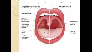 Les angine aigues Pr kharoubi meilleure explication 🤩🤩  ORL  ECN [upl. by Anyzratak]