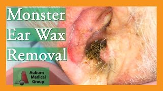 Monster Ear Wax Removal Brings New Life to JOKESTER Patient  Auburn Medical Group [upl. by Elocyn]