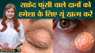 Milia यानी Skin पर सफ़ेद फुंसी वाले Pimples को आसानी से खत्म करने का तरीका  Sehat ep 78 [upl. by Ibbetson]