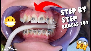 Dental Braces  Step by Step  Tooth Time Family Dentistry New Braunfels [upl. by Nomyt972]