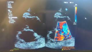 Patient presents to the clinic with chest pain and you see this short axis what do you suspect [upl. by Claudetta]