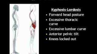 What is Kyphosis Lordosis [upl. by Malaspina596]