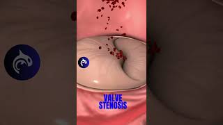 How you fix a Narrowed Heart Valve in 3D Animation valvuloplasty medicalanimation [upl. by Welbie582]