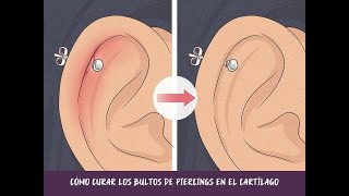 Cómo curar los bultos de piercings en el cartílago [upl. by Oirottiv]