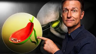 Gallbladder Removal Surgery  Vital Things to Know MUST WATCH [upl. by Kiley621]