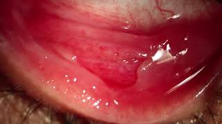 Pseudomembranes removal in Epidemic Keratoconjunctivitis [upl. by Enitsirhk990]