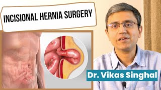 👉🏻 Incisional Hernia Surgery Best Treatment of Incisional Hernia In Delhi NCR [upl. by Croft]