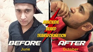 6 Month Beard Transformation with Minoxidil Before and After [upl. by Ethelda401]