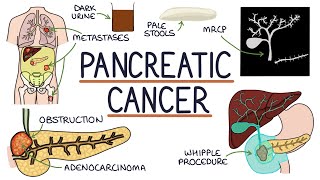 Understanding Pancreatic Cancer [upl. by Marlena650]