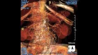 Iliac Artery Aneurysm Repair [upl. by Allesig]