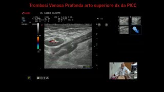 Trombosi Venosa Profonda da PICC al braccio destro [upl. by Ydnor]