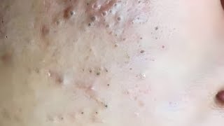 New blackheads BYoungSpa [upl. by Cyprus72]