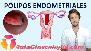 PÓLIPOS UTERINOS Causas riesgo de cáncer diagnóstico y tratamiento  Ginecología y Obstetricia [upl. by Baoj]