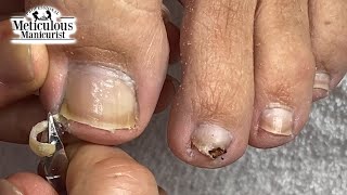 Take Care of Your Toenail Pain at Home Online Ingrown Pedicure Lesson [upl. by Haman847]