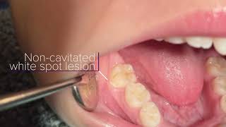 Curodont Repair Tutorial for Enamel Remineralization and Minimally Invasive Cavity Prevention [upl. by Nagle880]