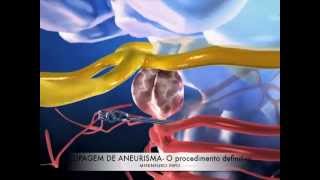 ANEURISMA CEREBRAL  CLIPAGEM [upl. by Riancho922]