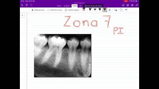 LO QUE SE VE EN UNA RADIOGRAFÍA DENTAL Zona 7 de premolares inferiores [upl. by Efram]