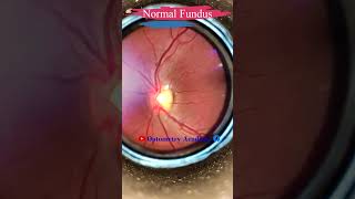 Normal fundus  Normal Retina  Smartphone Fundus Videography  Fundus Photography  Short Video 88 [upl. by Terrene]