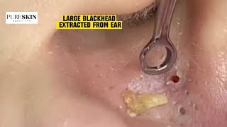 LARGE BLACKHEAD EXTRACTED FROM EAR  PURESKIN Beauty Spa Reacts Dr Dona Cravos asmr [upl. by Faso210]