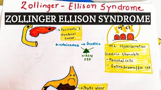 Zollinger Ellison Syndrome  Explained in hindi [upl. by Jago843]