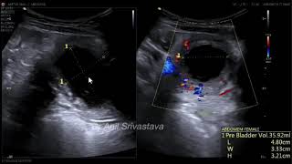 Detrusor Areflexia amp hyperreflexia [upl. by Steward492]