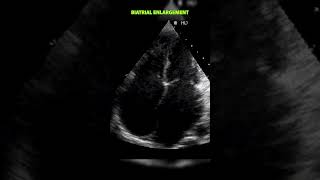 Biatrial Enlargement [upl. by Bentley887]