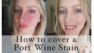 How to cover a Port Wine Stain birthmark [upl. by Krista885]