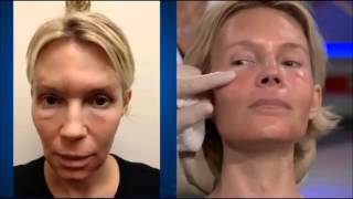 Dr Ourian Demonstrates Fractora  The Mini Face Lift [upl. by Lang]