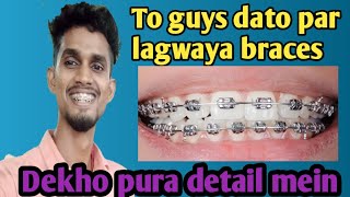 braces typesbraces lagane ke bad brush and afterbraces journy after before br braces on te [upl. by Aicirtam]