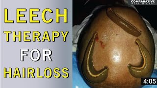 Leech Therapy  Leach In Hair  Hair Loss Treatment  Leech Therapy For Hair Loss  Health Tips [upl. by Atsilac826]