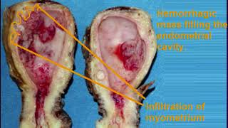 Endometrial carcinoma gross and microscopic features for medical students [upl. by Gertrude641]