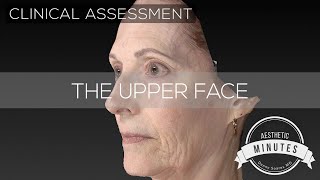 67 yo Female Brow Lift amp Facelift  Aesthetic Minutes BrowLift [upl. by Penland136]