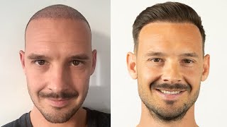 Mein Haartransplantation Verlauf  Alle Vorher Nachher Bilder [upl. by Eimaj]