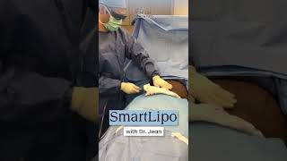 SmartLipo With Dr Jean Smartlipo [upl. by Ahseital]