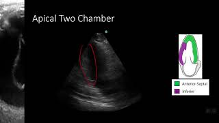 PointofCare Echo Regional Wall Motion Abnormalities [upl. by Piegari282]