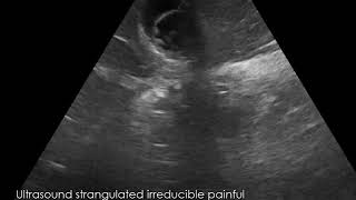 CASE 584 Ultrasound strangulated irreducible painful umblical herniafluid [upl. by Cordelie250]