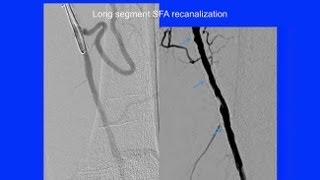 Options to Improve Endovascular Treatment of Claudication and CLI  UCSF Vascular Surgery Symposium [upl. by Jeno30]