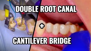 90 Double Root Canal  Cantilever Bridge [upl. by Ahsimot]